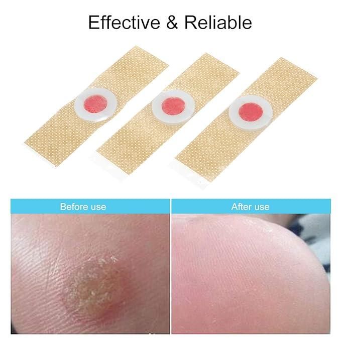 Corn Remover Pads – Pack of 24 for Foot Care & Comfort