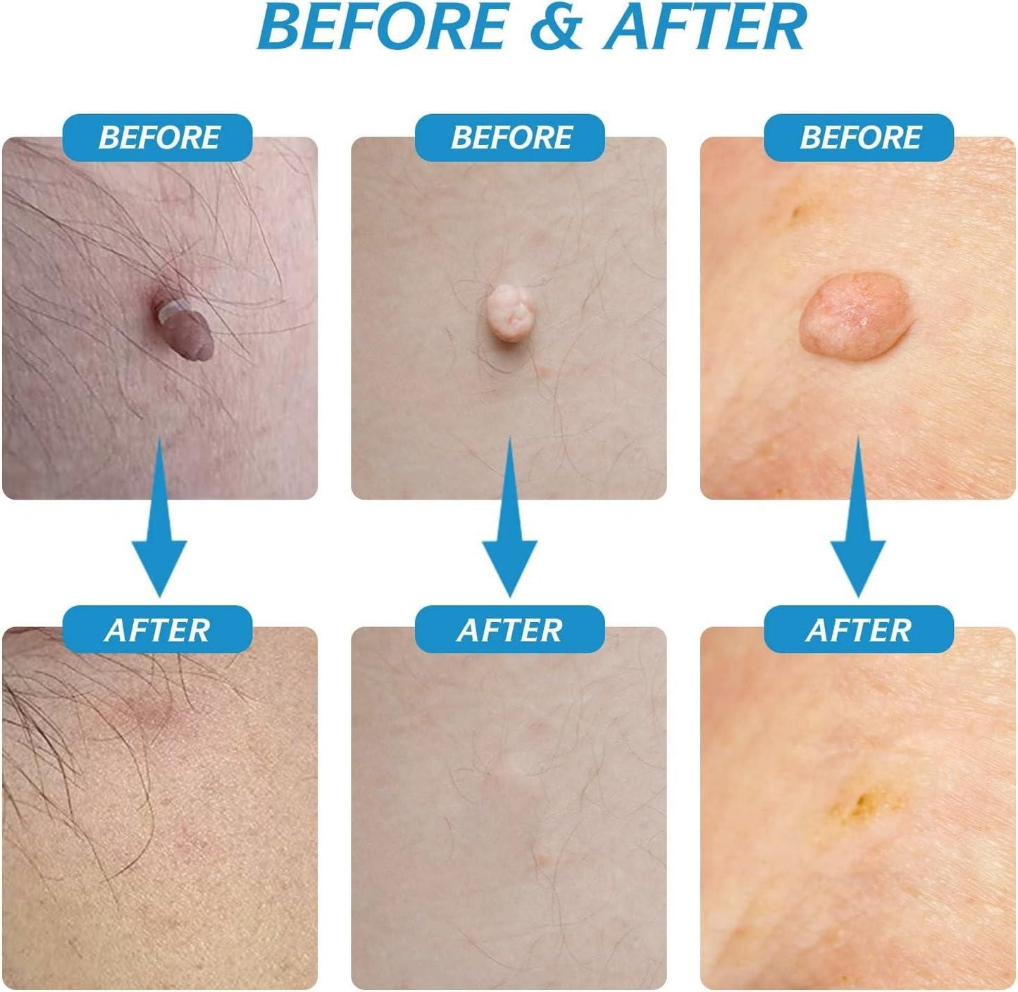 2-in-1 Skin Tag Remover Kit | Painless & Natural Skin Care Tool